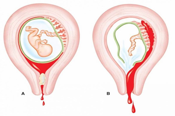 Tình trạng sót rau sau sinh được xử lý nhưng có thể vẫn để lại tổn thương cho thành tử cung